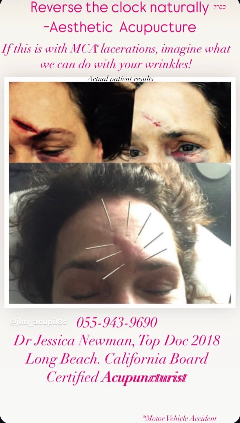 Aesthetic acupuncture promotional image showing before and after photos of facial acupuncture treatments for wrinkles and anti-aging